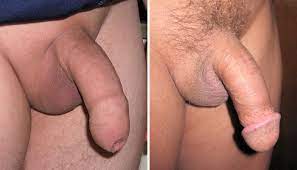 Файл:Uncircumcised and circumcised penis.JPG — Википедия
