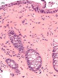 Image result for Radiation Colitis