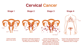 Surgery, radiation, chemotherapy or a combination of the three may be used. Cervical Cancer Patient Care