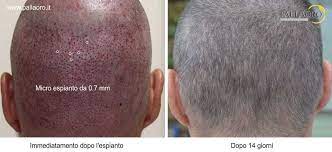 Signing out of account, standby. Dopo Quanto Tempo Dal Trapianto Cadono Le Crosticine Clinica Pallaoro