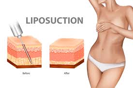 How much does liposuction cost? Tumescent Liposuction Cost Prices List 2021 Review