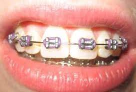 lig colours colors page 7 metal mouth message board braces colors cute braces colors teeth braces