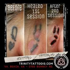 Dec 20, 2010 · laser tattoo removal carries a much lower risk of scarring than any physically destructive method to remove the tattoo (ranging from excision to deeper peels or dermabrasion). Trinity Tattoo Co One Dot At A Time Making Progress On This Behind The Ear Removal Using Tatt2away Tattooremoval Tatt2away Allnatural Allnaturaltattooremoval Nonlaser Nonlasertattooremoval Tattoobegone Secondsession Removal Giveitachance