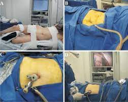 The department's head nurse used the sealed cards to allocate the participants into groups. A Patient Placed On Left Lateral Decubitus Position B Creation Of Download Scientific Diagram