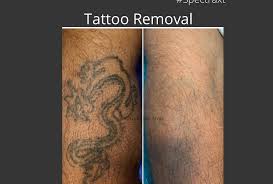The versatile lumina ® offers laser tattoo removal as well as over 24 other aesthetic treatments. Best Overview Helpful For Tattoo Removal Before And After An Overview New Fashion 365 2021