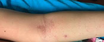 Eine innere blutung (hämorrhagie) ist eine im körper verbleibende blutung, die sich in geweben, organen oder körperhöhlen, darunter kopf, brust und eine innere blutung tritt auf, wenn blut aus einer arterie oder vene aus dem kreislaufsystem austritt und sich im innern des körpers ansammelt. Petechien Aussehen Ursachen Behandlung