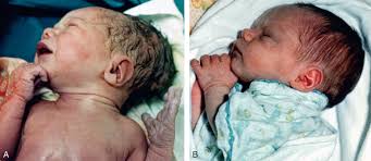 Image result for Craniotabes