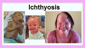 Image result for Ichthyosis