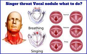 Vocal Cord Nodules Hoarseness Singers Throat Homeopathic Treatment By Drmakkar A A A µa A A A A A A