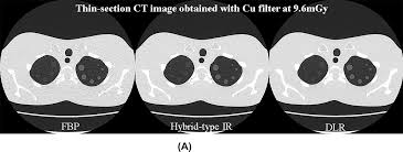 Capability for dose reduction while maintaining nodule detection:  Comparison of silver and copper X-ray spectrum modulation filters for chest  CT using a phantom study with different reconstruction methods - European  Journal of