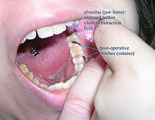 Alveolitis Sicca Wikipedia