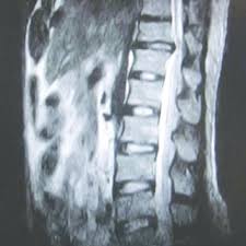 Sagital T1w Mri Image Showing L4 L5 Sequestered Disc Hernia Behind L5 Download Scientific Diagram
