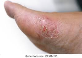 Image result for Tinnea vesiculosa