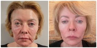 Recently had Neogen Plasma Treatment