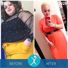 gastric sleeve before and after photos