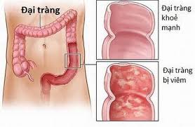 Biện pháp điều trị bệnh thường là phẫu thuật. 5 Triá»‡u Chá»©ng Viem Ä'áº¡i Trang Khong Thá»ƒ Bá» Qua Vtv Vn