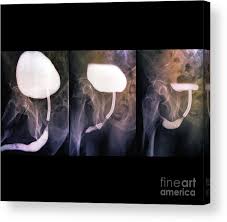 Image result for Voiding Cystourethrogram