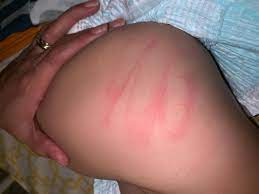 Hand mark on bottom - August 2017 Babies | Forums | What to Expect