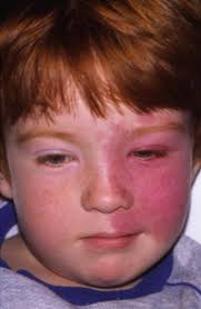 Vascular Anomalies of the Head and Neck