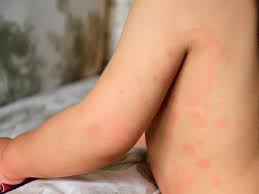 Urticaria En Ninos Que Hacer Para Tratarla