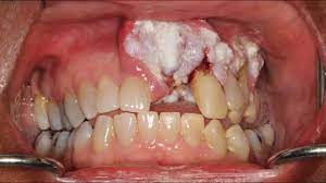 Finding a sore in your mouth can be scary, and you may not know whether to schedule a professional evaluation or to take the. Woman S Mouth Cancer Goes Ignored By Dentists For Years Youtube