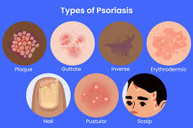 Image result for psoriasis