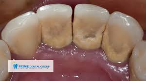 Image result for Gingivitis