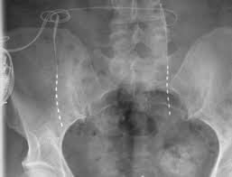 Check spelling or type a new query. Periphere Neurostimulation Pns Klinikum Brandenburg