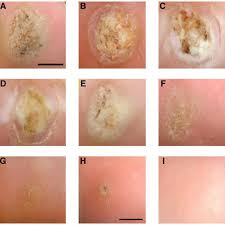 Browse through our collection of images of feet and feet pics. Presentation Of Recalcitrant Plantar Warts Plantar Wart On The Left Download Scientific Diagram