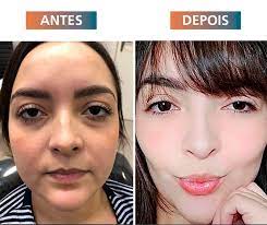 Antes e depois das grandes modelos dos anos 1990. Bichectomia Tedesco Odontologia Dentista Em Santana