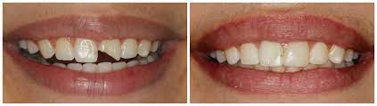 Even if your tooth repair falls under the category of a basic procedure, your insurer probably won't pay all of the cost. How To Fix A Chipped Tooth At Home Arxiusarquitectura