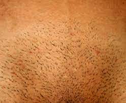 From a health standpoint, removing pubic hair can lead to irritation of the hair follicle, and open wounds or nicks, which may increase the risk for. 237 Pubic Hair Stock Photos And Images 123rf