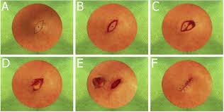 3 in the very occasional instances when multiple proliferating. Overview Of Epidermoid Cyst Sciencedirect