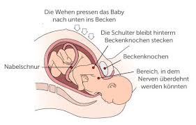 Geburt — was bezahlt die ab wann dreht sich baby in geburtsposition behördenwege nach der geburt. Schulterdystokie Babycenter