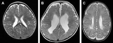 It is the second most common complication involving the central nervous system in premature. Periventricular Leukomalacia Pvl Grades Determined On The Basis Of Download Scientific Diagram