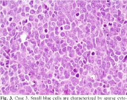 Histologic appearance of nodular merkel cell carcinoma. Pdf Merkel Cell Carcinoma Our Experience In This Rare Pathology Semantic Scholar