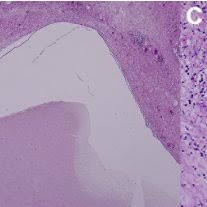 Expert reviewer, dr anton alexandroff, consultant dermatologist next review due birthmarks are markings on your skin. Pdf Primary Intestinal Lymphangiectasia With Massive Abdominal Lymphatic Malformation Requiring Surgical Debulking