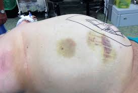 Hernia Gigante Nueva Tecnica Para Tratar Hernias Grandes Y Complicadassantos Prieto Cirujanos En Santiago De Compostela
