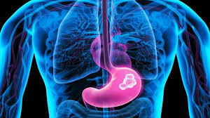 What are the common signs and symptoms of stomach cancer? Ayurvedic Remedies For Gastric Cancer Stomach Cancer Ayurvedic Treatment