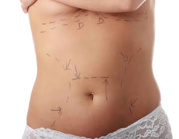 Abdominoplastie à Paris - Dr Bannier