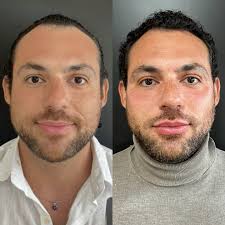 BELEZA MASCULINA: PREENCHIMENTO MANDIBULAR ✨ Você sabia que o preenchimento  com ácido hialurônico na linha da mandíbula é o artifício de beleza mais  procurado atualmente pelos homens depois do Botox? Homens bonitos