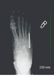 Autogenous bone graft is the gold standard bone graft material. A Guide To Intramedullary Fixation Of Jones Fractures Podiatry Today