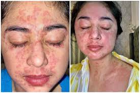 Dewi Perssik Kena Covid 19 Kok Bisa Kulit Merah Merah Antara News