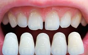 Dental Veneers Quality And Price Mountain View Dental