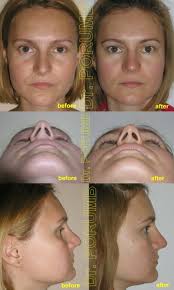 Aceasta deviatie a septului este in nasul nostru de mici, dar ne va deranja poate la 30 de ani, poate la 50 ani. Rinoplastie Septoplastie ClinicÄ ExclusivistÄ La Standarde Occidentale