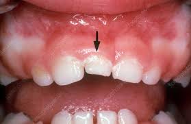 Dens, tooth] medical dictionary for the health professions and nursing © farlex 2012 Mesiodens Keyword Search Science Photo Library