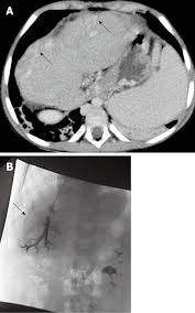 Left untreated or with failure of the kasai procedure, biliary atresia progresses towards … Mdct Mr And Interventional Radiology In Biliary Atresia Candidates For Liver Transplantation