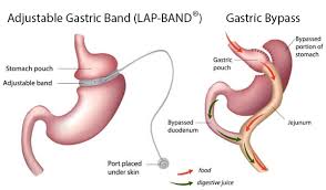 Lap Band Vs Gastric Bypass All You Need To Know Bariatric Surgery Source Gastric Bypass Bariatric Surgery Lap Band