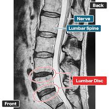 Image result for Low Back Imaging