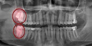 Sometimes, wisdom teeth that have become impacted or haven't fully broken through the surface of. Impacted Wisdom Teeth Causes Consequences Treatment
